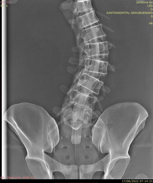 CT Scan of Lumbar Spine Torso Posterior view